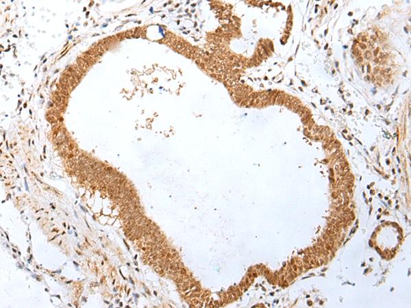 PEG3 Antibody - Immunohistochemistry of paraffin-embedded Human gastric cancer tissue  using PEG3 Polyclonal Antibody at dilution of 1:45(×200)