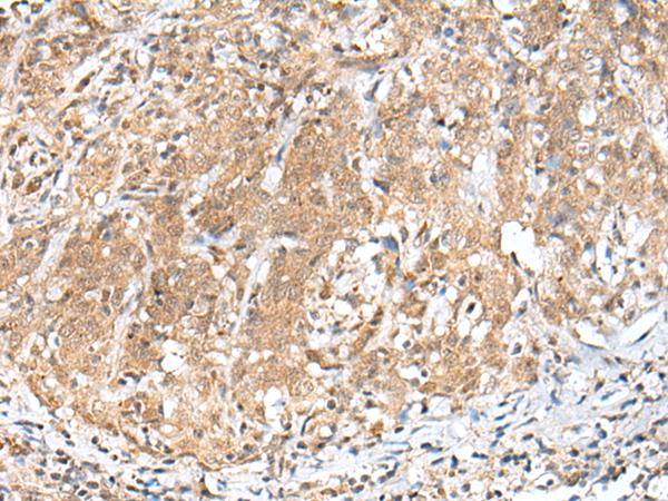 PEG3 Antibody - Immunohistochemistry of paraffin-embedded Human cervical cancer tissue  using PEG3 Polyclonal Antibody at dilution of 1:45(×200)