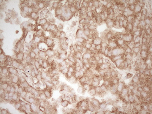 PELI1 / Pellino 1 Antibody - IHC of paraffin-embedded Adenocarcinoma of Human ovary tissue using anti-PELI1 mouse monoclonal antibody. (Heat-induced epitope retrieval by 1 mM EDTA in 10mM Tris, pH8.5, 120°C for 3min).