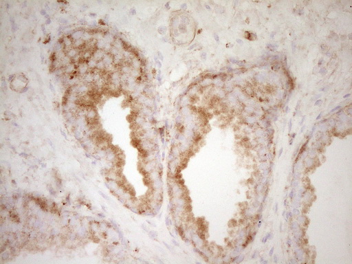 PELI1 / Pellino 1 Antibody - IHC of paraffin-embedded Carcinoma of Human prostate tissue using anti-PELI1 mouse monoclonal antibody. (Heat-induced epitope retrieval by 1 mM EDTA in 10mM Tris, pH8.5, 120°C for 3min).