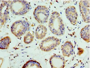 PELI1 / Pellino 1 Antibody - Immunohistochemistry of paraffin-embedded human breast cancer using antibody at 1:100 dilution.