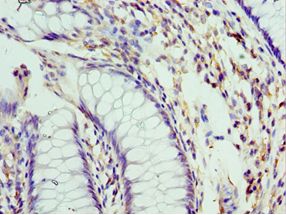 PELI1 / Pellino 1 Antibody - Immunohistochemistry of paraffin-embedded human colon cancer using antibody at 1:100 dilution.