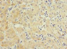PELI3 / Pellino 3 Antibody - Immunohistochemistry of paraffin-embedded human liver cancer at dilution 1:100