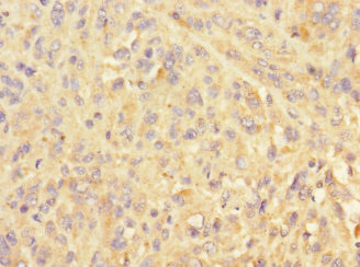 PELI3 / Pellino 3 Antibody - Immunohistochemistry of paraffin-embedded human melanoma at dilution 1:100