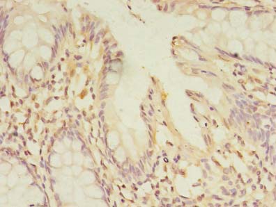 PELO Antibody - Immunohistochemistry of paraffin-embedded human colon cancer using antibody at dilution of 1:100.