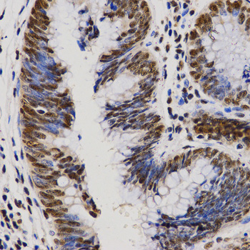 PELP1 Antibody - Immunohistochemistry of paraffin-embedded human rectal cancer tissue.