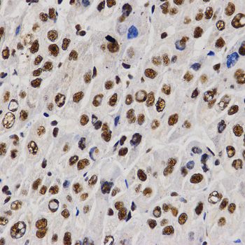 PELP1 Antibody - Immunohistochemistry of paraffin-embedded human liver cancer using PELP1 antibody at dilution of 1:200 (40x lens).