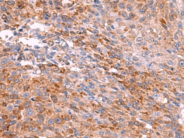 PEMT Antibody - Immunohistochemistry of paraffin-embedded Human colorectal cancer tissue  using PEMT Polyclonal Antibody at dilution of 1:55(×200)