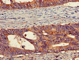 PEPD / PROLIDASE Antibody - Immunohistochemistry of paraffin-embedded human colon cancer using PEPD Antibody at dilution of 1:100