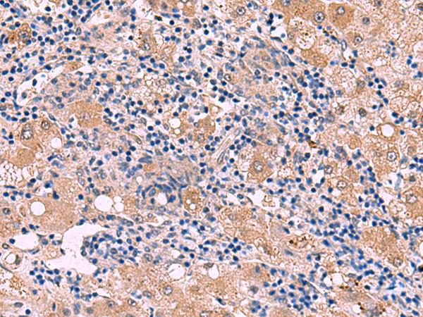 PEPD / PROLIDASE Antibody - Immunohistochemistry of paraffin-embedded Human liver cancer tissue  using PEPD Polyclonal Antibody at dilution of 1:85(×200)