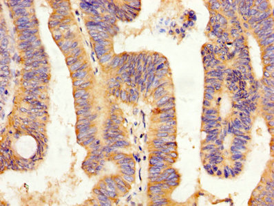 Peptide YY / PYY Antibody - IHC image of PYY Antibody diluted at 1:200 and staining in paraffin-embedded human colon cancer performed on a Leica BondTM system. After dewaxing and hydration, antigen retrieval was mediated by high pressure in a citrate buffer (pH 6.0). Section was blocked with 10% normal goat serum 30min at RT. Then primary antibody (1% BSA) was incubated at 4°C overnight. The primary is detected by a biotinylated secondary antibody and visualized using an HRP conjugated SP system.
