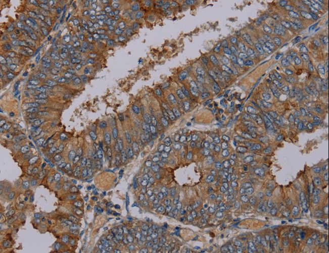 Peptide YY / PYY Antibody - Immunohistochemistry of paraffin-embedded Human thyroid cancer using PYY Polyclonal Antibody at dilution of 1:30.