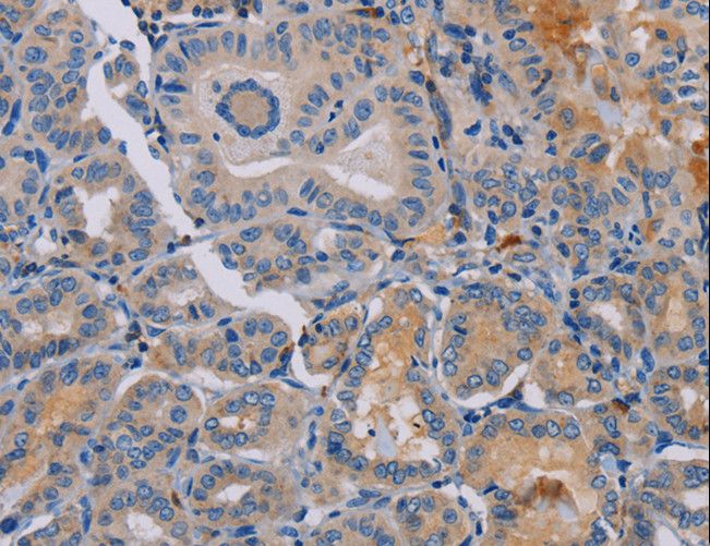 Peptide YY / PYY Antibody - Immunohistochemistry of paraffin-embedded Human thyroid cancer using PYY Polyclonal Antibody at dilution of 1:30.