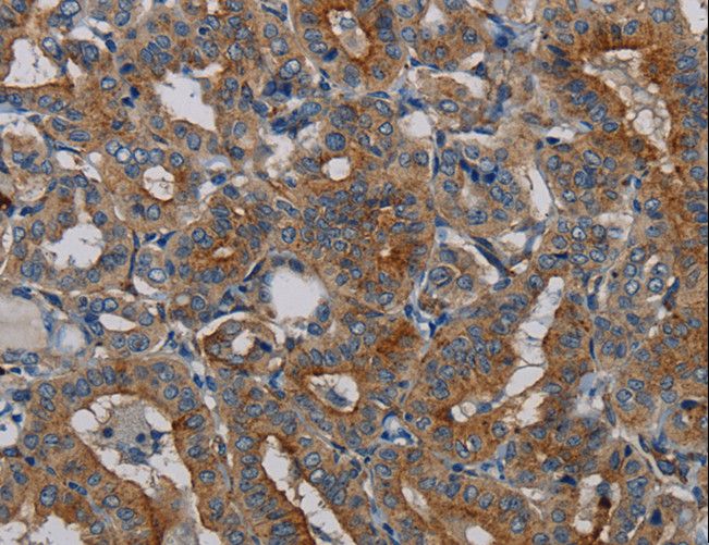 PER2 Antibody - Immunohistochemistry of paraffin-embedded Human lung cancer using PER2 Polyclonal Antibody at dilution of 1:50.