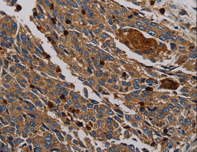 PER2 Antibody - Immunohistochemistry of paraffin-embedded Human lung cancer using PER2 Polyclonal Antibody at dilution of 1:50.