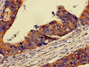 PER3 Antibody - Immunohistochemistry of paraffin-embedded human colon cancer at dilution of 1:100