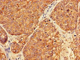 PER3 Antibody - Immunohistochemistry of paraffin-embedded human ovarian cancer at dilution of 1:100