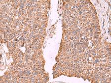 PER3 Antibody - Immunohistochemistry of paraffin-embedded Human esophagus cancer tissue  using PER3 Polyclonal Antibody at dilution of 1:55(×200)