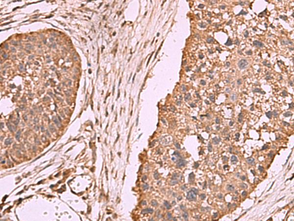 PER3 Antibody - Immunohistochemistry of paraffin-embedded Human esophagus cancer tissue  using PER3 Polyclonal Antibody at dilution of 1:70(×200)