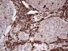 Peripherin Antibody - Immunohistochemical staining of paraffin-embedded Carcinoma of Human lung tissue using anti-PRPH mouse monoclonal antibody. (Heat-induced epitope retrieval by 1 mM EDTA in 10mM Tris, pH8.5, 120C for 3min,