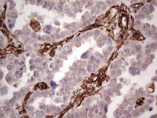 Peripherin Antibody - Immunohistochemical staining of paraffin-embedded Adenocarcinoma of Human ovary tissue using anti-PRPH mouse monoclonal antibody. (Heat-induced epitope retrieval by 1 mM EDTA in 10mM Tris, pH8.5, 120C for 3min,