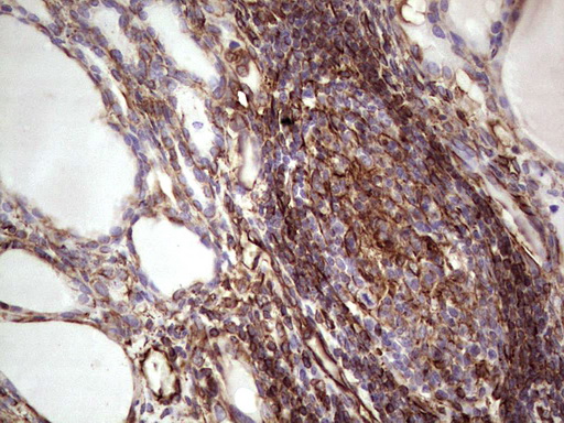 Peripherin Antibody - Immunohistochemical staining of paraffin-embedded Human thyroid tissue within the normal limits using anti-PRPH mouse monoclonal antibody. (Heat-induced epitope retrieval by 1 mM EDTA in 10mM Tris, pH8.5, 120C for 3min,