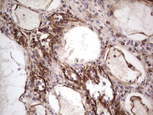 Peripherin Antibody - Immunohistochemical staining of paraffin-embedded Carcinoma of Human thyroid tissue using anti-PRPH mouse monoclonal antibody. (Heat-induced epitope retrieval by 1 mM EDTA in 10mM Tris, pH8.5, 120C for 3min,