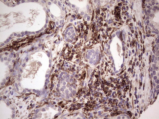 Peripherin Antibody - Immunohistochemical staining of paraffin-embedded Carcinoma of Human prostate tissue using anti-PRPH mouse monoclonal antibody. (Heat-induced epitope retrieval by 1 mM EDTA in 10mM Tris, pH8.5, 120C for 3min,