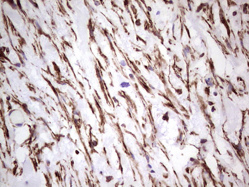 Peripherin Antibody - Immunohistochemical staining of paraffin-embedded Carcinoma of Human bladder tissue using anti-PRPH mouse monoclonal antibody. (Heat-induced epitope retrieval by 1 mM EDTA in 10mM Tris, pH8.5, 120C for 3min,