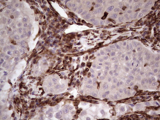 Peripherin Antibody - IHC of paraffin-embedded Carcinoma of Human lung tissue using anti-PRPH mouse monoclonal antibody. (Heat-induced epitope retrieval by 1 mM EDTA in 10mM Tris, pH8.5, 120°C for 3min).