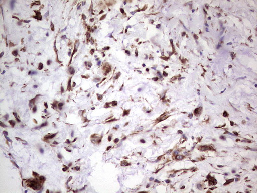 Peripherin Antibody - IHC of paraffin-embedded Carcinoma of Human pancreas tissue using anti-PRPH mouse monoclonal antibody. (Heat-induced epitope retrieval by 1 mM EDTA in 10mM Tris, pH8.5, 120°C for 3min).