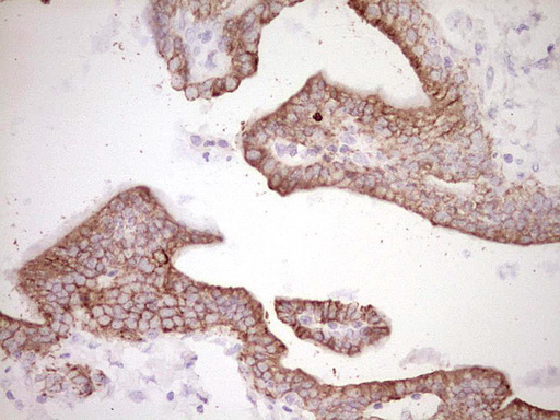 Peripherin Antibody - Immunohistochemical staining of paraffin-embedded Carcinoma of Human pancreas tissue using anti-PRPH mouse monoclonal antibody. (Heat-induced epitope retrieval by 1 mM EDTA in 10mM Tris, pH8.5, 120C for 3min,