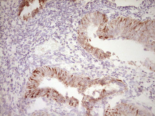 Peripherin Antibody - Immunohistochemical staining of paraffin-embedded Adenocarcinoma of Human endometrium tissue using anti-PRPH mouse monoclonal antibody. (Heat-induced epitope retrieval by 1 mM EDTA in 10mM Tris, pH8.5, 120C for 3min,
