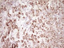 Peripherin Antibody - IHC of paraffin-embedded Adenocarcinoma of Human breast tissue using anti-PRPH mouse monoclonal antibody. (Heat-induced epitope retrieval by 1 mM EDTA in 10mM Tris, pH8.5, 120°C for 3min).