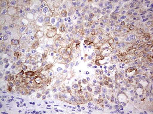 Peripherin Antibody - IHC of paraffin-embedded Carcinoma of Human lung tissue using anti-PRPH mouse monoclonal antibody. (Heat-induced epitope retrieval by 1 mM EDTA in 10mM Tris, pH8.5, 120°C for 3min).