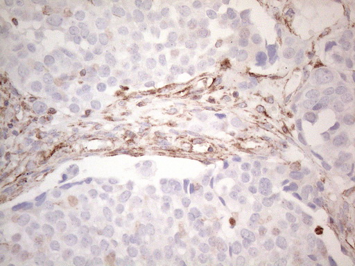 Peripherin Antibody - Immunohistochemical staining of paraffin-embedded Adenocarcinoma of Human ovary tissue using anti-PRPH mouse monoclonal antibody. (Heat-induced epitope retrieval by 1mM EDTA in 10mM Tris buffer. (pH8.0) at 110C for 10 min. (1:200)