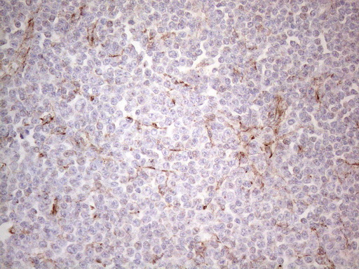 Peripherin Antibody - Immunohistochemical staining of paraffin-embedded Human lymphoma tissue using anti-PRPH mouse monoclonal antibody. (Heat-induced epitope retrieval by 1mM EDTA in 10mM Tris buffer. (pH8.0) at 110C for 10 min. (1:200)