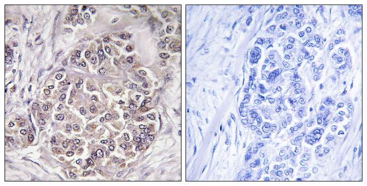 PEX1 Antibody - Immunohistochemistry analysis of paraffin-embedded human breast carcinoma tissue, using PEX1 Antibody. The picture on the right is blocked with the synthesized peptide.