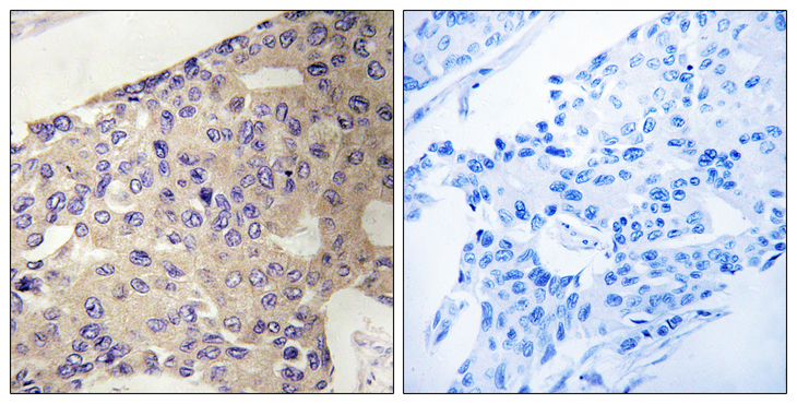 PEX10 Antibody - Immunohistochemistry analysis of paraffin-embedded human breast carcinoma tissue, using PEX10 Antibody. The picture on the right is blocked with the synthesized peptide.