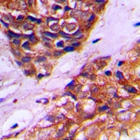PEX10 Antibody - Immunohistochemical analysis of PEX10 staining in human prostate cancer formalin fixed paraffin embedded tissue section. The section was pre-treated using heat mediated antigen retrieval with sodium citrate buffer (pH 6.0). The section was then incubated with the antibody at room temperature and detected with HRP and DAB as chromogen. The section was then counterstained with hematoxylin and mounted with DPX.