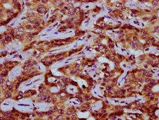 PEX11A Antibody - Immunohistochemistry Dilution at 1:200 and staining in paraffin-embedded human liver cancer performed on a Leica BondTM system. After dewaxing and hydration, antigen retrieval was mediated by high pressure in a citrate buffer (pH 6.0). Section was blocked with 10% normal Goat serum 30min at RT. Then primary antibody (1% BSA) was incubated at 4°C overnight. The primary is detected by a biotinylated Secondary antibody and visualized using an HRP conjugated SP system.