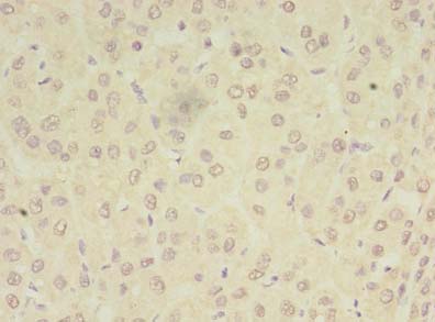 PEX11B Antibody - Immunohistochemistry of paraffin-embedded human liver cancer using antibody at dilution of 1:100.