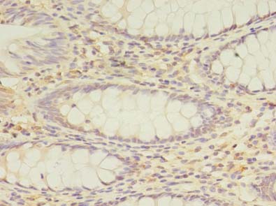 PEX11B Antibody - Immunohistochemistry of paraffin-embedded human colon cancer using antibody at dilution of 1:100.