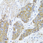 PEX14 Antibody - Immunohistochemistry of paraffin-embedded human prostate cancer tissue.