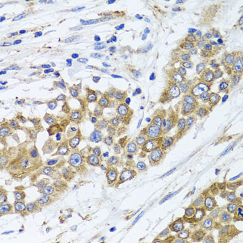 PEX14 Antibody - Immunohistochemistry of paraffin-embedded human colon carcinoma tissue.