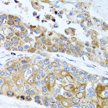 PEX14 Antibody - Immunohistochemistry of paraffin-embedded human lung cancer tissue.