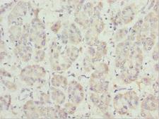 PEX14 Antibody - Immunohistochemistry of paraffin-embedded human liver cancer at dilution 1:100