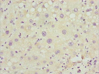 PEX14 Antibody - Immunohistochemistry of paraffin-embedded human liver cancer at dilution 1:100
