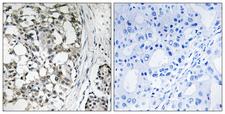 PEX14 Antibody - Peptide - + Immunohistochemistry analysis of paraffin-embedded human breast carcinoma tissue using PEX14 antibody.