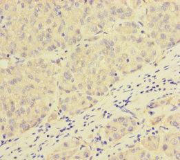 PEX16 Antibody - Immunohistochemistry of paraffin-embedded human liver cancer at dilution of 1:100